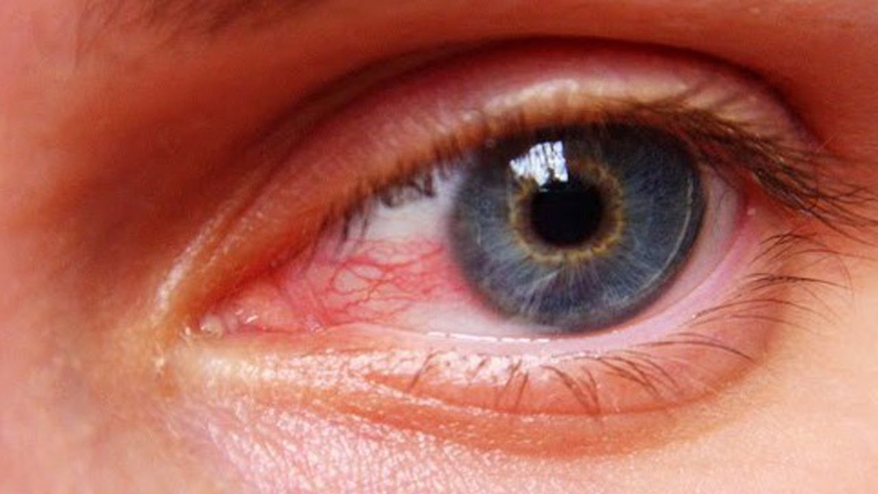 سبب العيون الحمراء التي تظهر في صور الأشخاص هو